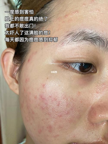 脸上有油有痘痘怎么办男人 脸上有油有痘痘怎么办男人