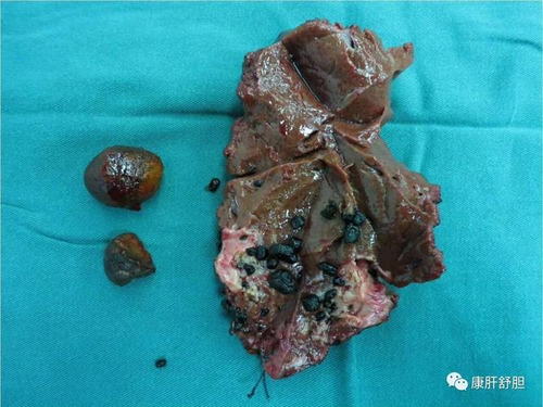 胆囊结石该怎么治疗有药可以吃吗 胆囊结石该怎么治疗有药可以吃吗