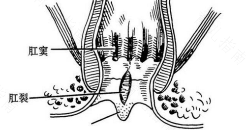 大便干燥肛门破裂出血怎么办 大便干燥肛门破裂出血怎么办