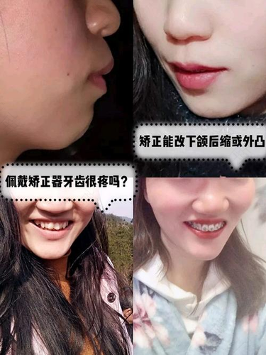 矫正牙齿牙疼怎么办