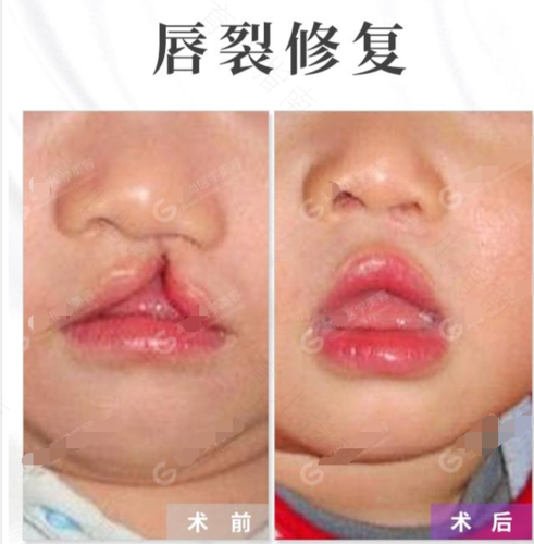 孩子兔唇怎么办 孩子兔唇怎么办
