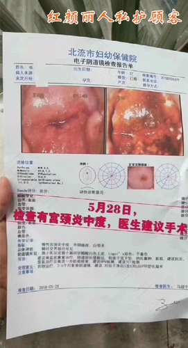 子宫糜烂中度严重吗? 子宫糜烂中度严重吗?