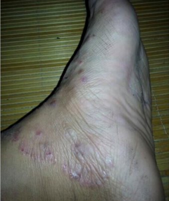 脚面长湿疹怎么办