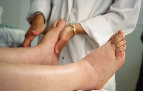 肾炎为什么会导致水肿怎么办 肾炎为什么会导致水肿怎么办