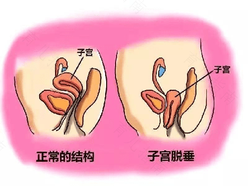 功血切除子宫能好吗 功血切除子宫能好吗