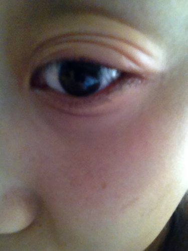 眼睛周围肿是怎么回事 眼睛周围肿是怎么回事