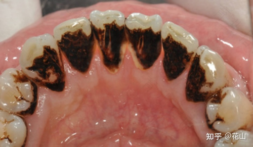 缺钙牙齿会变黑吗 缺钙牙齿会变黑吗