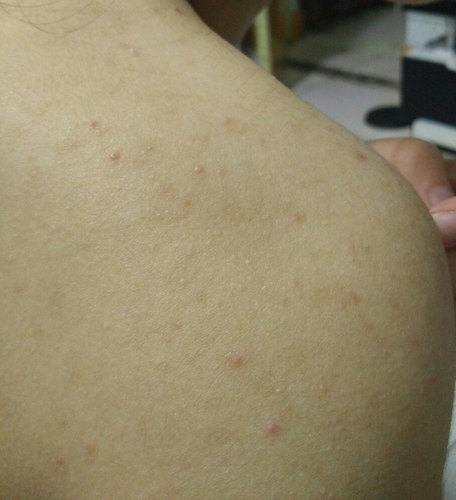 后背总是起疙瘩怎么回事 后背总是起疙瘩怎么回事