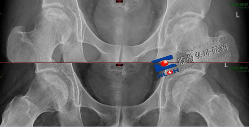 股骨头塌陷症状 股骨头塌陷症状