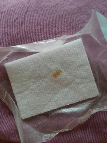 肚脐发炎小腹疼痛怎么回事 肚脐发炎小腹疼痛怎么回事