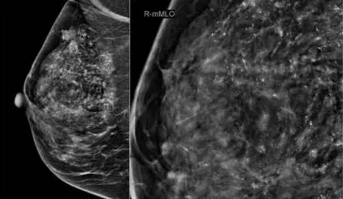 左侧乳腺内点状钙化灶是什么意思 左侧乳腺内点状钙化灶是什么意思