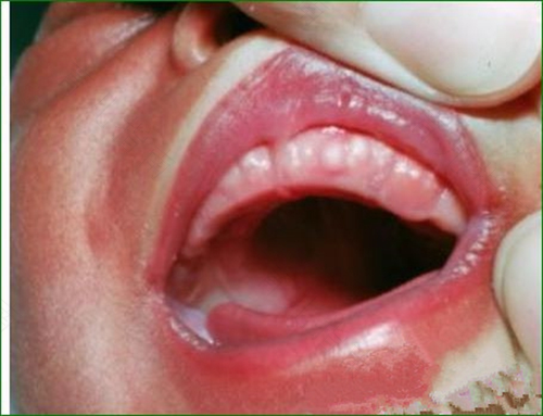 生口疮怎么治疗 生口疮怎么治疗