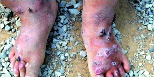 艾滋病急性期拉肚子什么特征 艾滋病急性期拉肚子什么特征