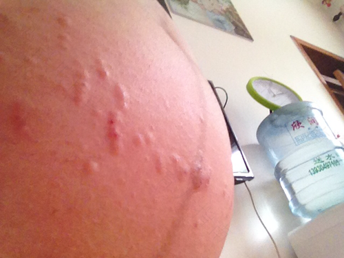 小肚子痒怎么回事 小肚子痒怎么回事