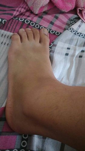 脚脖子疼是怎么回事? 脚脖子疼是怎么回事?