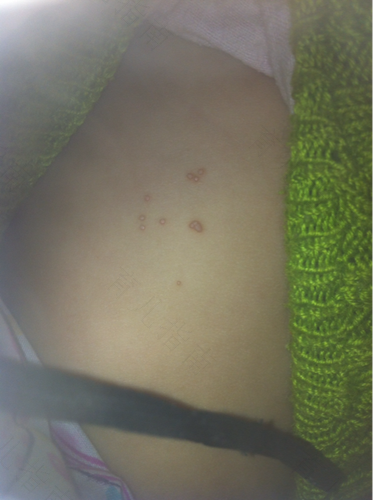 出疹子体温会降低吗 出疹子体温会降低吗