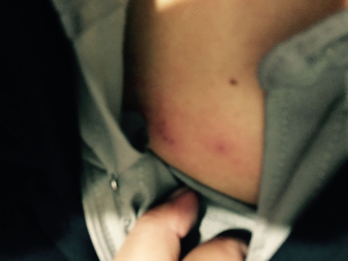 胸部痒是怎么回事 胸部痒是怎么回事