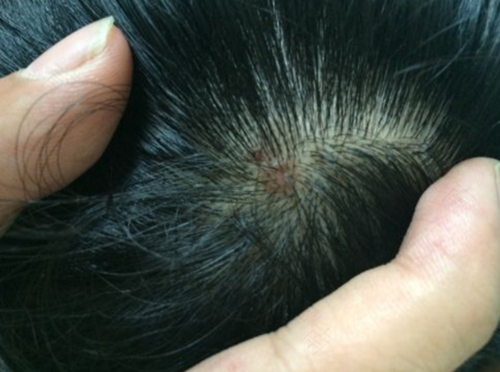 毛囊炎反反复复治不好怎么办 毛囊炎反反复复治不好怎么办