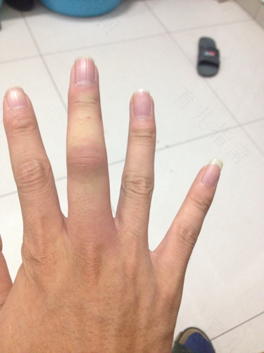 手指头突然肿胀疼痛怎么回事?怎么办? 手指头突然肿胀疼痛怎么回事?怎么办?