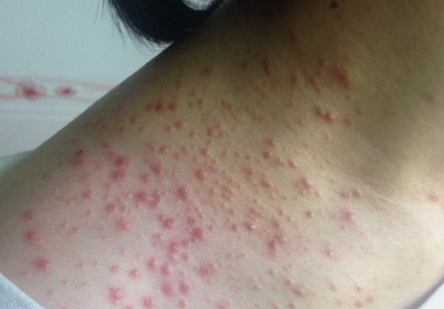 湿疹是不是都会痒 湿疹是不是都会痒