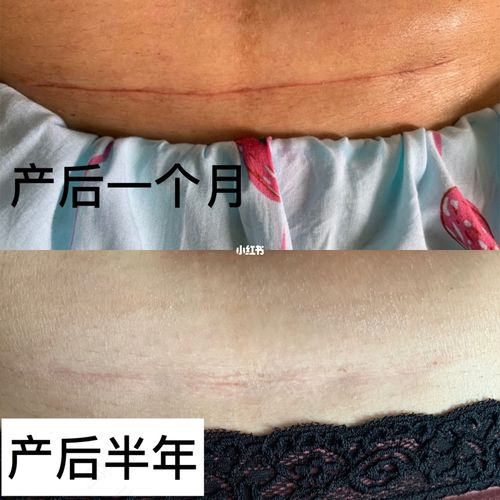 剖腹产疤痕的误区，你了解吗