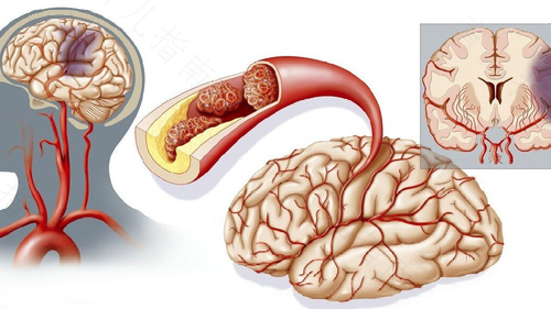 怎样治疗大脑缺氧缺血 怎样治疗大脑缺氧缺血