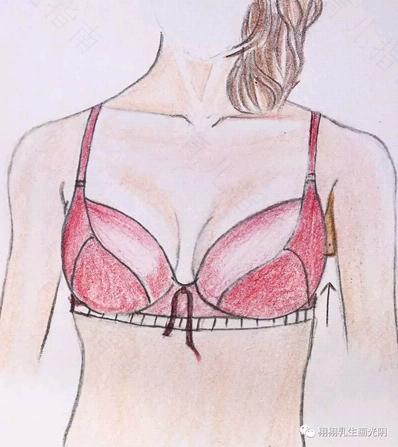 副乳和腋臭可以一起手术吗 副乳和腋臭可以一起手术吗