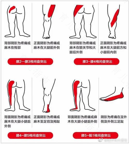 大腿肌肉发麻怎么回事 大腿肌肉发麻怎么回事