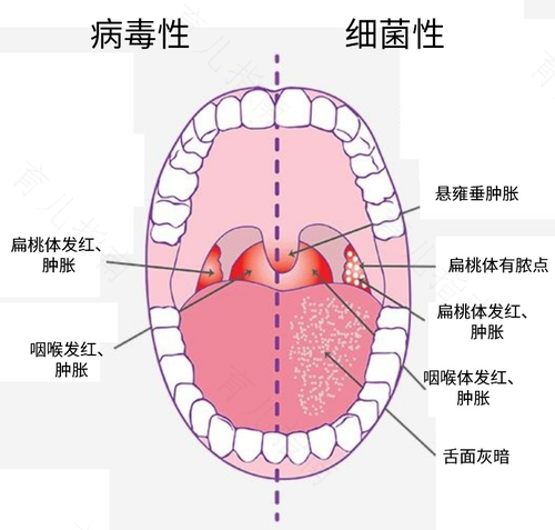 病毒性扁桃体炎吃什么药好 病毒性扁桃体炎吃什么药好