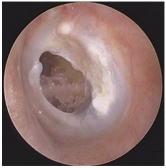 儿童慢性中耳炎能根治吗 儿童慢性中耳炎能根治吗