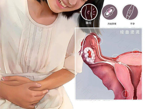 如何预防子宫内膜异位症复发 如何预防子宫内膜异位症复发