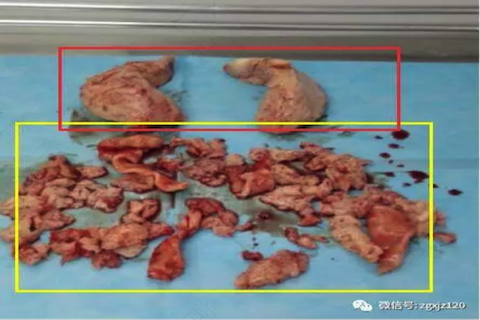 子宫腺肌瘤的怎么办 子宫腺肌瘤的怎么办