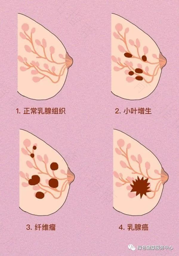 乳腺癌前期会疼吗 乳腺癌前期会疼吗