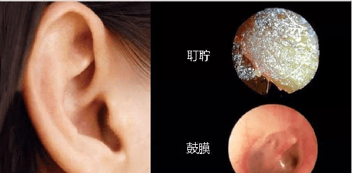 耳朵发炎堵住了怎么办 知乎 耳朵发炎堵住了怎么办 知乎