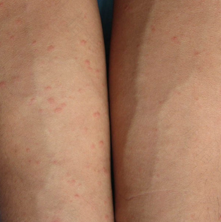 荨麻疹伴有发烧怎么办 荨麻疹伴有发烧怎么办