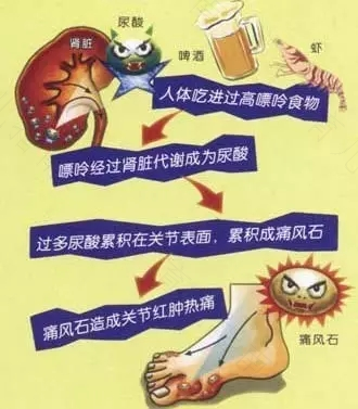 尿酸高的症状有哪些特点 尿酸高的症状有哪些特点