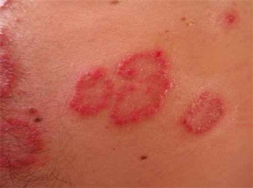 玫瑰湿疹是什么引起的 玫瑰湿疹是什么引起的