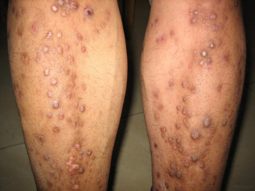 结节性痒疹怎么能除根 结节性痒疹怎么能除根