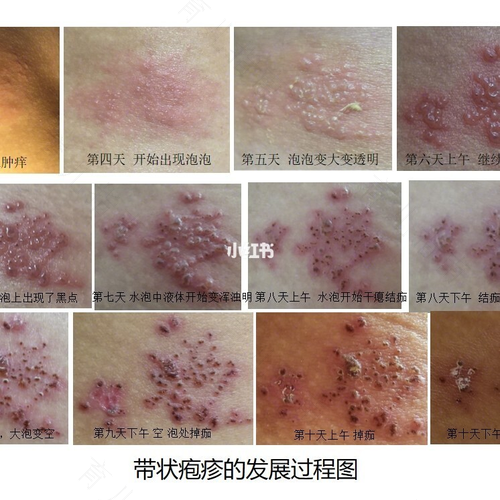 带状疱疹感染了怎么办