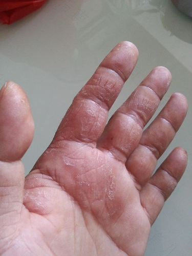 手上得了湿疹怎么治疗才好 手上得了湿疹怎么治疗才好