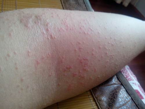 宝宝屁股湿疹破皮怎么办 宝宝屁股湿疹破皮怎么办