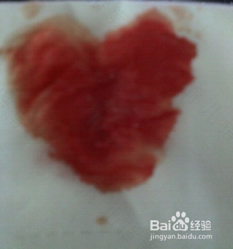 高血压拔牙后出血不止怎么办 高血压拔牙后出血不止怎么办