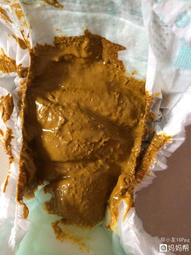 大便长期恶臭怎么回事 大便长期恶臭怎么回事