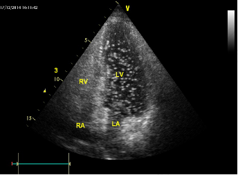 脏器声学造影检查需多久出结果 脏器声学造影检查需多久出结果
