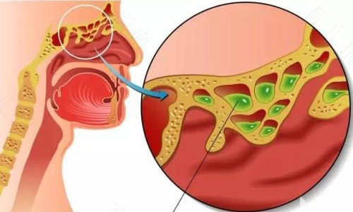 孕妇鼻炎痰多怎么办 孕妇鼻炎痰多怎么办
