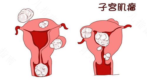 子宫肌瘤应该注意哪些事项 子宫肌瘤应该注意哪些事项