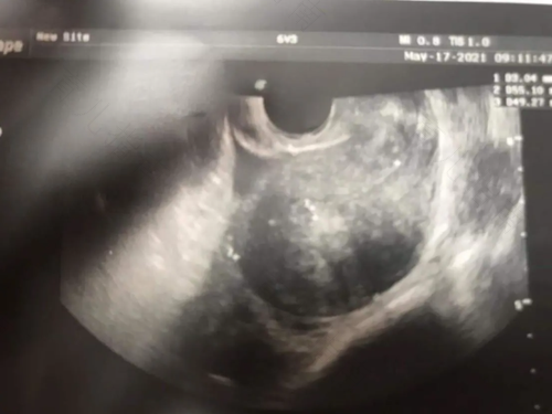 b超显示子宫肌瘤可能是什么意思 b超显示子宫肌瘤可能是什么意思