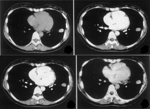 肺部ct造影剂的副作用怎么解除 肺部ct造影剂的副作用怎么解除