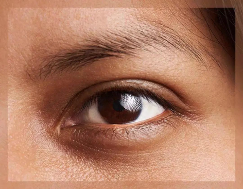 打完除皱针出现黑眼圈怎么办