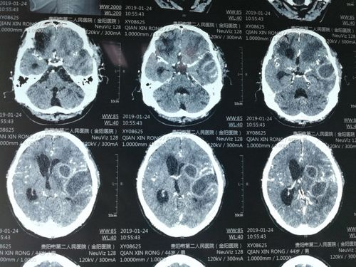 颅内感染是什么原因引起的 颅内感染是什么原因引起的